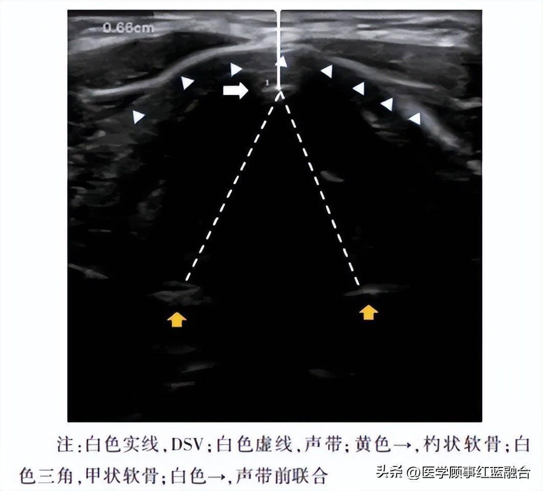 05甲狀腺峽部氣管環至皮膚距離(distance from skin to thyroid