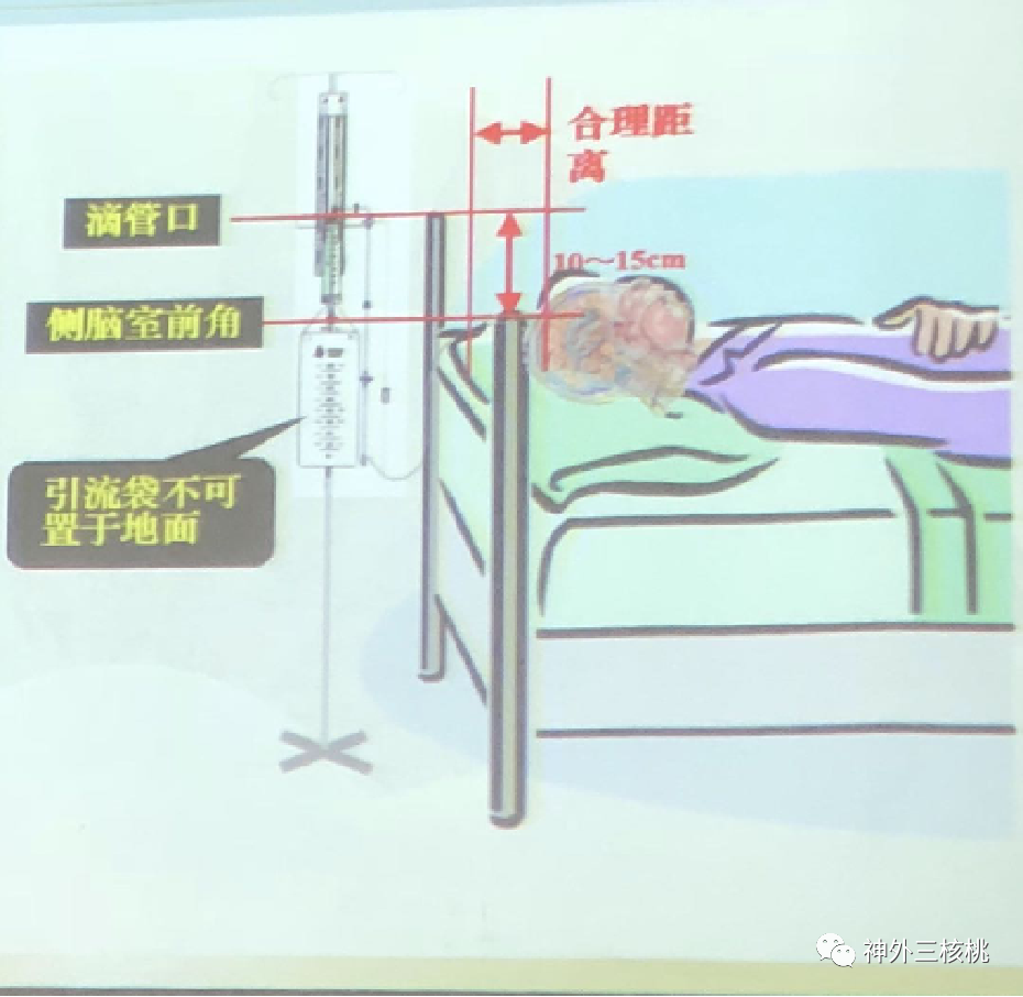 脑积水疾病的健康宣教_脑室_手术_患者