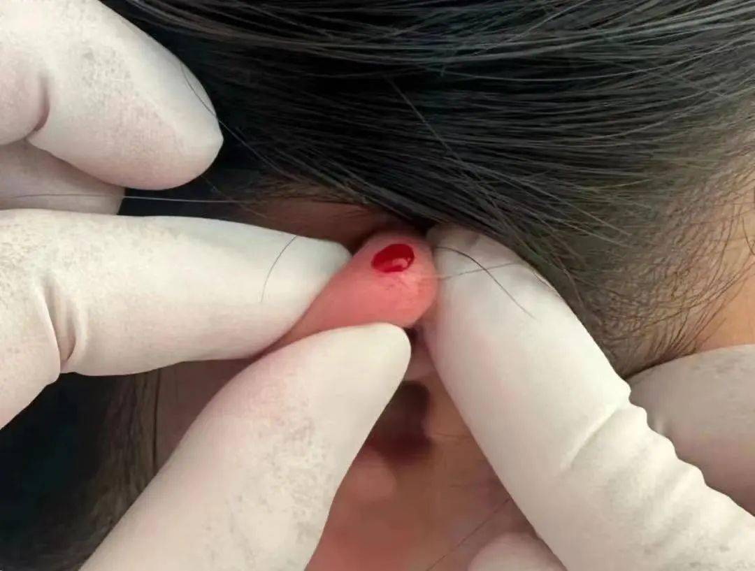 耳尖放血01肺炎急性期内外治结合一直是红会儿科的特色亮点