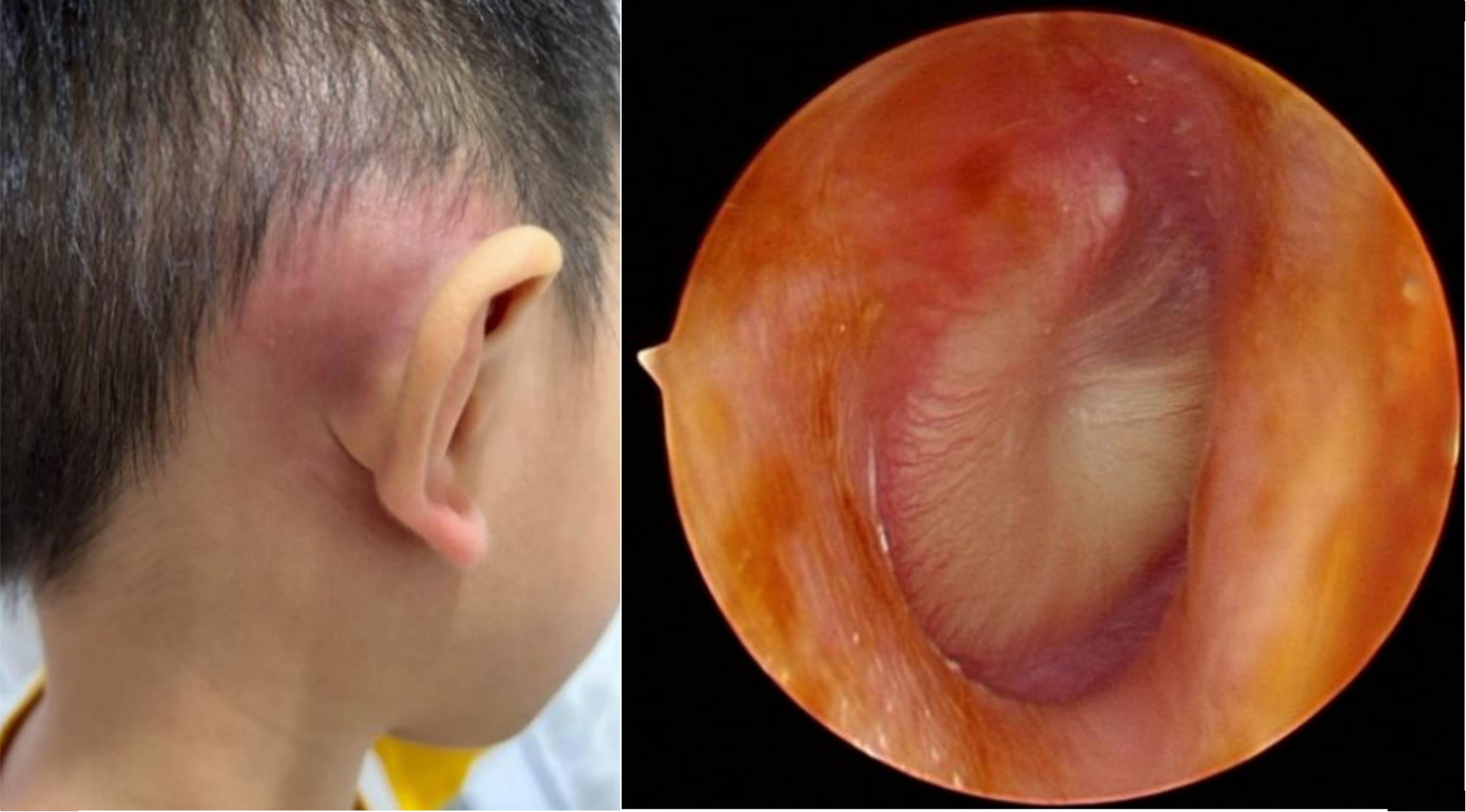 分泌性中耳炎症状图片