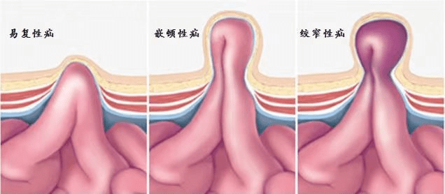 手術_治療_腹股溝