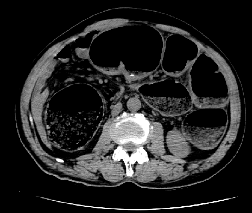 肠梗阻ct表现图片大全图片
