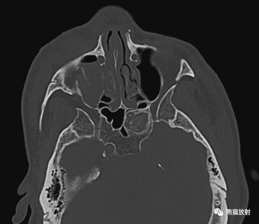 颧骨ct图片