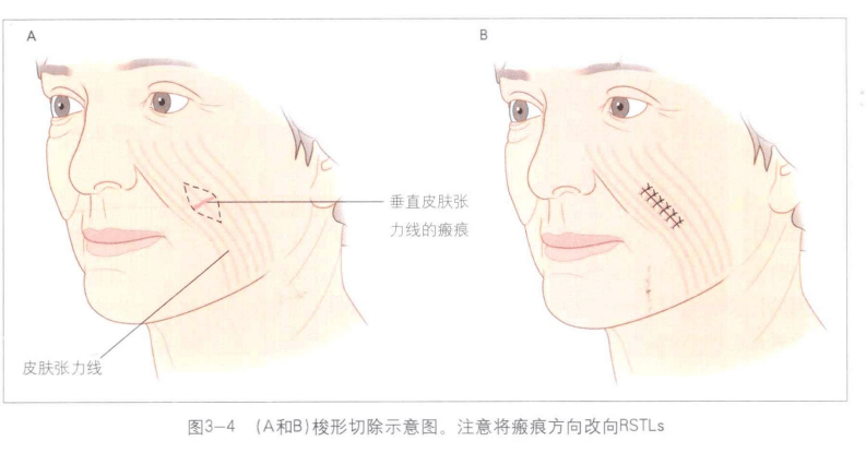 很多家長會關心如果發生增生性瘢痕,什麼時候做手術比較合適呢?