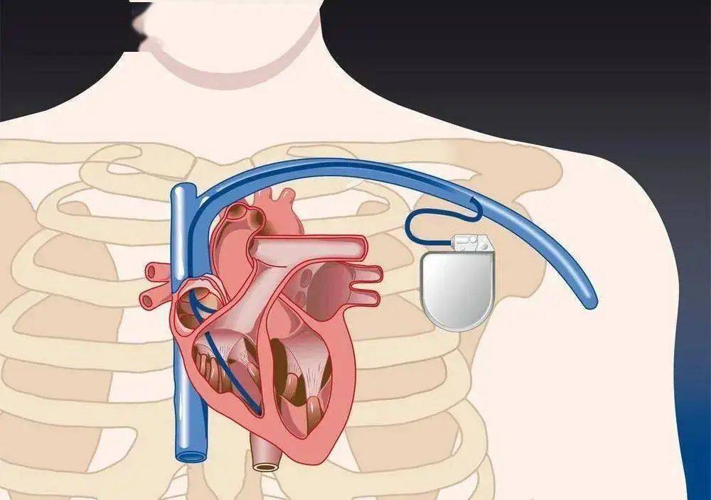 心脏起搏器多大图片图片