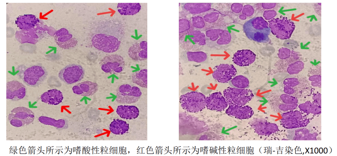 【知識集錦】胸腔積液嗜酸性粒細胞增多的原因及漿膜腔細胞形態檢驗的