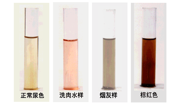 兒童正常尿液的顏色為淡黃,透明色,如果尿液呈現茶色,洗肉水色,菸灰色